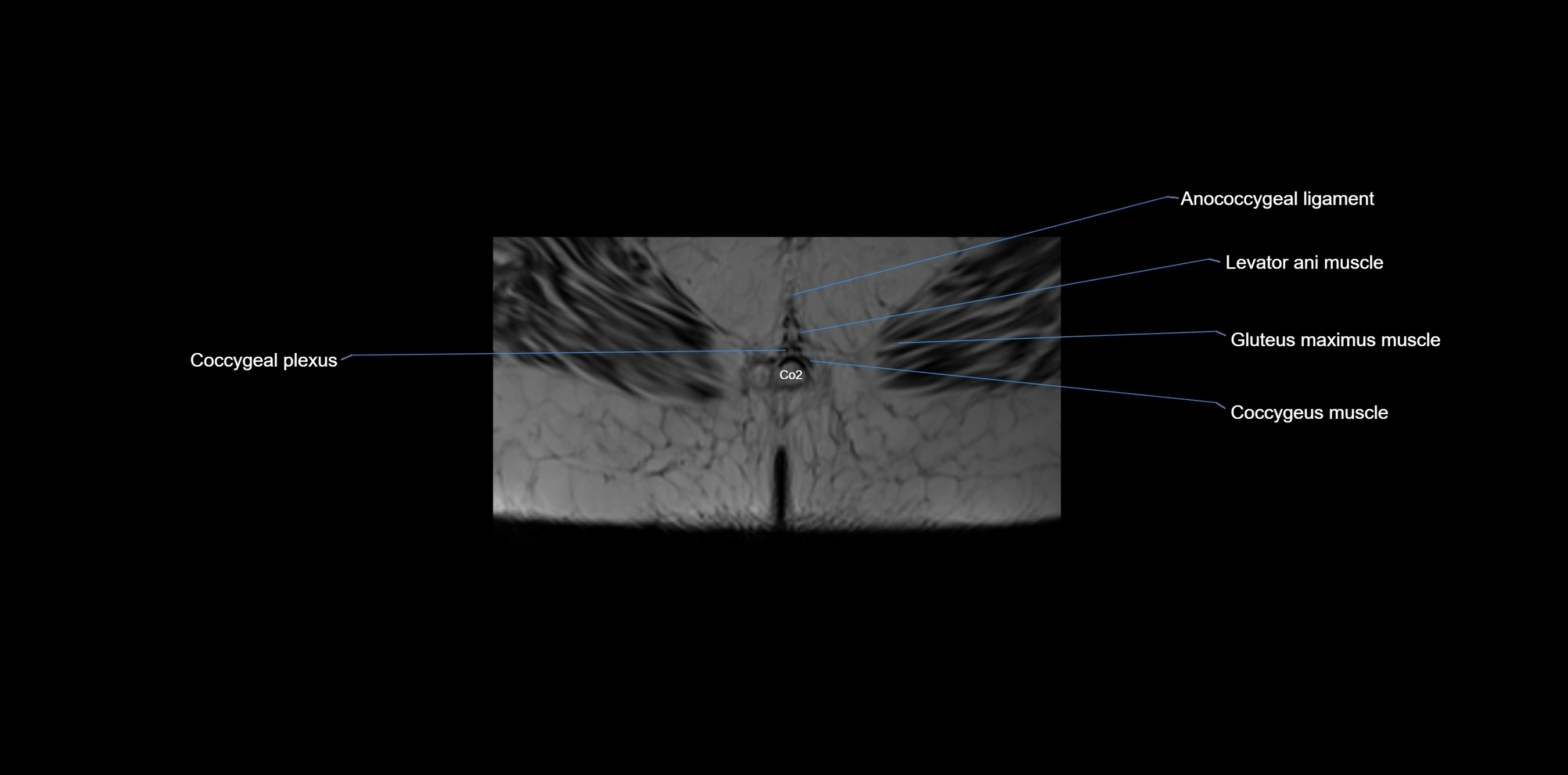MRI sacrum, coccyx and sacroiliac joint axial cross sectional anatomy 3T  radiology  image-img-00001-00079.webp